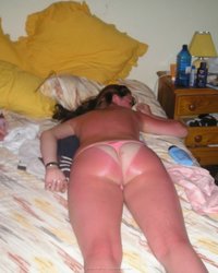 Девка уснула на пляже и ее кожа стала красной 12 фото